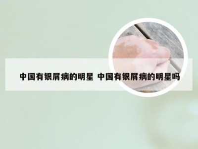 中国有银屑病的明星 中国有银屑病的明星吗