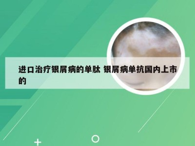 进口治疗银屑病的单肽 银屑病单抗国内上市的