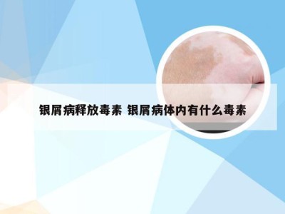 银屑病释放毒素 银屑病体内有什么毒素