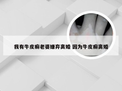 我有牛皮癣老婆嫌弃离婚 因为牛皮癣离婚