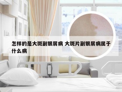 怎样的是大斑副银屑病 大斑片副银屑病属于什么病