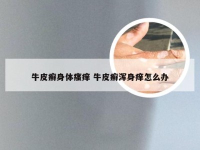 牛皮癣身体瘙痒 牛皮癣浑身痒怎么办