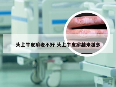 头上牛皮癣老不好 头上牛皮癣越来越多