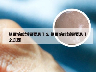 银屑病吃饭需要忌什么 银屑病吃饭需要忌什么东西