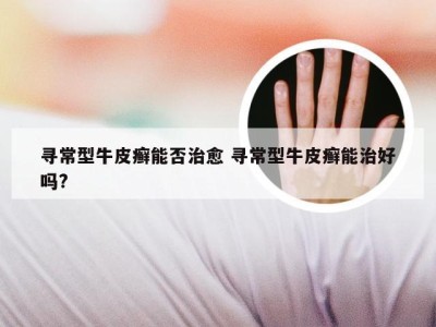 寻常型牛皮癣能否治愈 寻常型牛皮癣能治好吗?