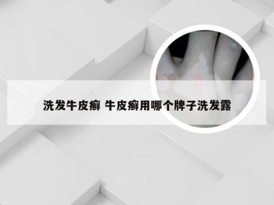 洗发牛皮癣 牛皮癣用哪个牌子洗发露