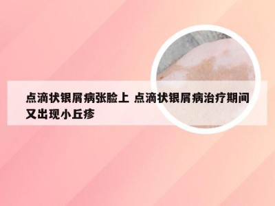 点滴状银屑病张脸上 点滴状银屑病治疗期间又出现小丘疹
