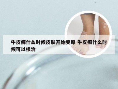 牛皮癣什么时候皮肤开始变厚 牛皮癣什么时候可以根治