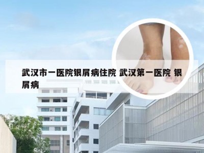 武汉市一医院银屑病住院 武汉第一医院 银屑病