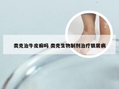 类克治牛皮癣吗 类克生物制剂治疗银屑病