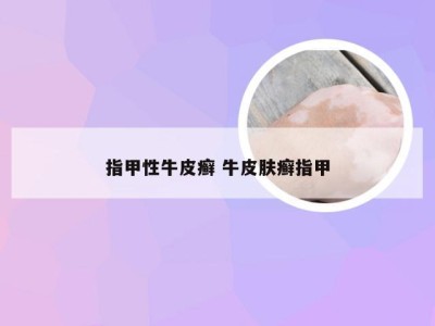 指甲性牛皮癣 牛皮肤癣指甲