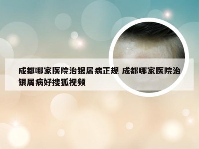 成都哪家医院治银屑病正规 成都哪家医院治银屑病好搜狐视频
