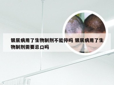 银屑病用了生物制剂不能停吗 银屑病用了生物制剂需要忌口吗