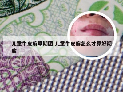 儿童牛皮癣早期图 儿童牛皮癣怎么才算好彻底