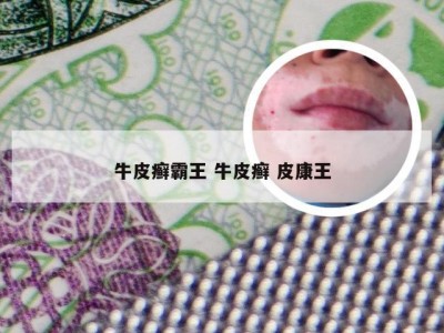牛皮癣霸王 牛皮癣 皮康王