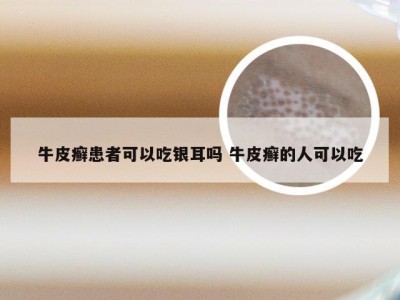 牛皮癣患者可以吃银耳吗 牛皮癣的人可以吃