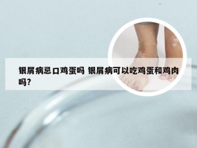 银屑病忌口鸡蛋吗 银屑病可以吃鸡蛋和鸡肉吗?