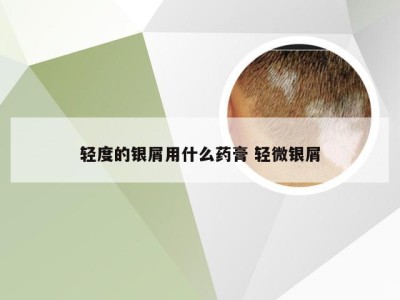 轻度的银屑用什么药膏 轻微银屑