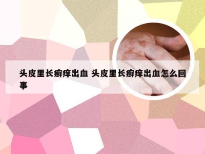 头皮里长癣痒出血 头皮里长癣痒出血怎么回事