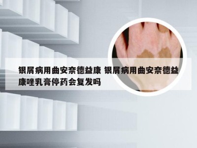 银屑病用曲安奈德益康 银屑病用曲安奈德益康唑乳膏停药会复发吗