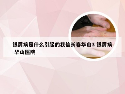 银屑病是什么引起的我信长春华山3 银屑病 华山医院