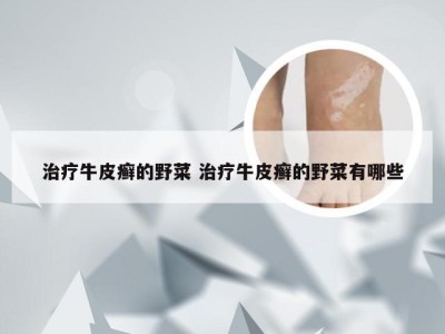 治疗牛皮癣的野菜 治疗牛皮癣的野菜有哪些