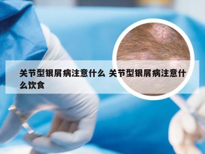 关节型银屑病注意什么 关节型银屑病注意什么饮食