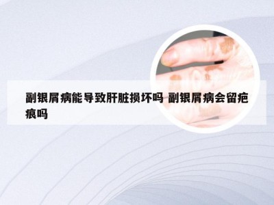 副银屑病能导致肝脏损坏吗 副银屑病会留疤痕吗