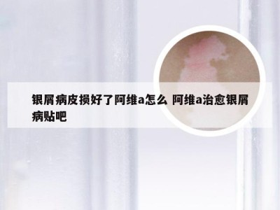 银屑病皮损好了阿维a怎么 阿维a治愈银屑病贴吧