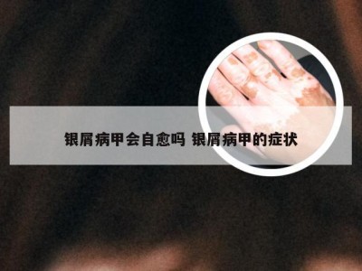 银屑病甲会自愈吗 银屑病甲的症状