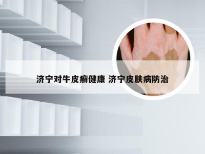 济宁对牛皮癣健康 济宁皮肤病防治