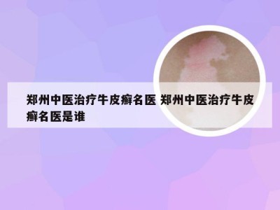 郑州中医治疗牛皮癣名医 郑州中医治疗牛皮癣名医是谁