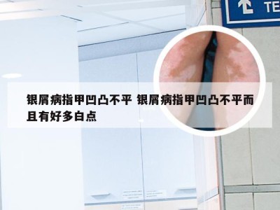 银屑病指甲凹凸不平 银屑病指甲凹凸不平而且有好多白点