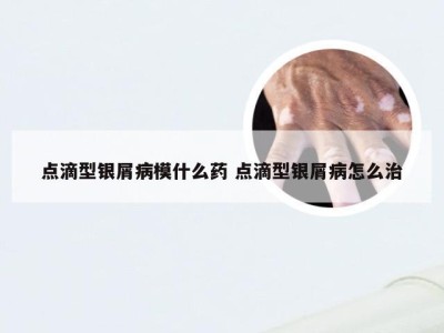 点滴型银屑病模什么药 点滴型银屑病怎么治