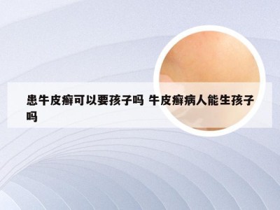 患牛皮癣可以要孩子吗 牛皮癣病人能生孩子吗