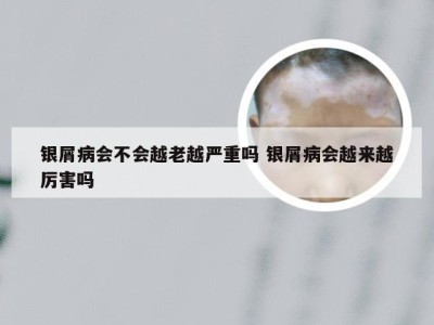 银屑病会不会越老越严重吗 银屑病会越来越厉害吗