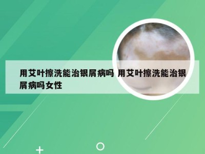 用艾叶擦洗能治银屑病吗 用艾叶擦洗能治银屑病吗女性