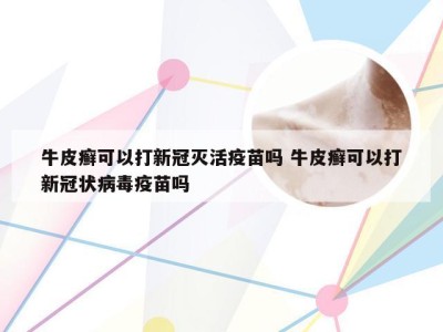 牛皮癣可以打新冠灭活疫苗吗 牛皮癣可以打新冠状病毒疫苗吗