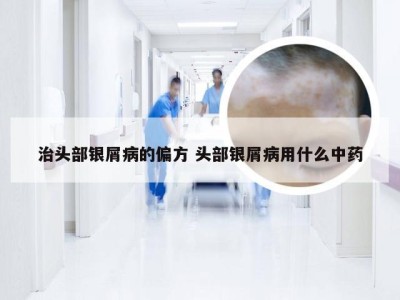 治头部银屑病的偏方 头部银屑病用什么中药