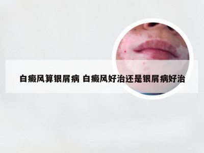 白癜风算银屑病 白癜风好治还是银屑病好治