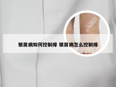 银屑病如何控制痒 银屑病怎么控制痒