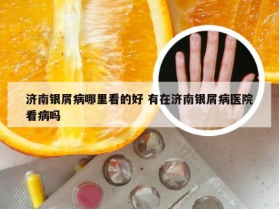 济南银屑病哪里看的好 有在济南银屑病医院看病吗