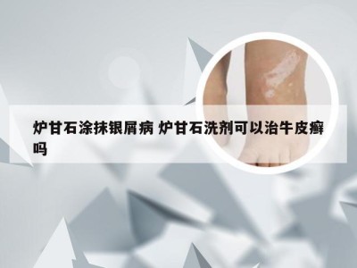 炉甘石涂抹银屑病 炉甘石洗剂可以治牛皮癣吗