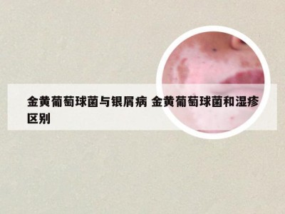 金黄葡萄球菌与银屑病 金黄葡萄球菌和湿疹区别
