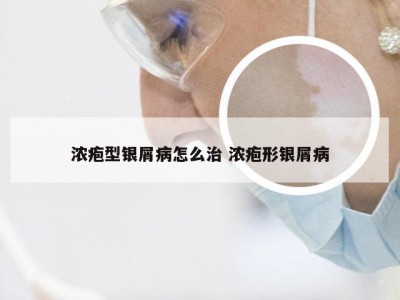 浓疱型银屑病怎么治 浓疱形银屑病