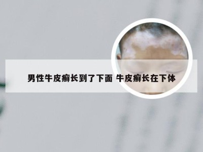 男性牛皮癣长到了下面 牛皮癣长在下体