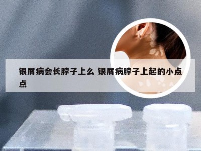 银屑病会长脖子上么 银屑病脖子上起的小点点