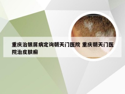 重庆治银屑病定询朝天门医院 重庆朝天门医院治皮肤癣