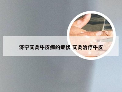 济宁艾灸牛皮癣的症状 艾灸治疗牛皮