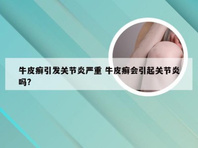 牛皮癣引发关节炎严重 牛皮癣会引起关节炎吗?